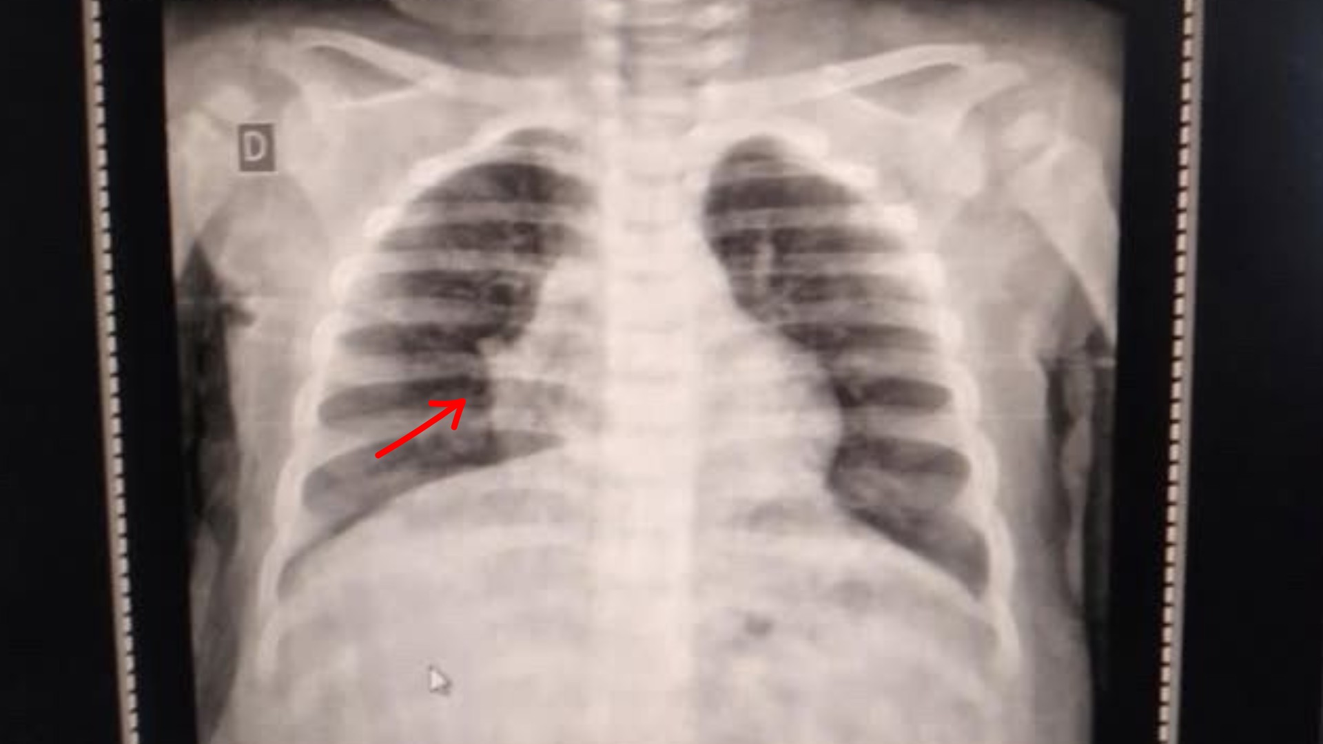 Bebê com pneumonia busca vaga hospitalar em Araçatuba após determinação judicial