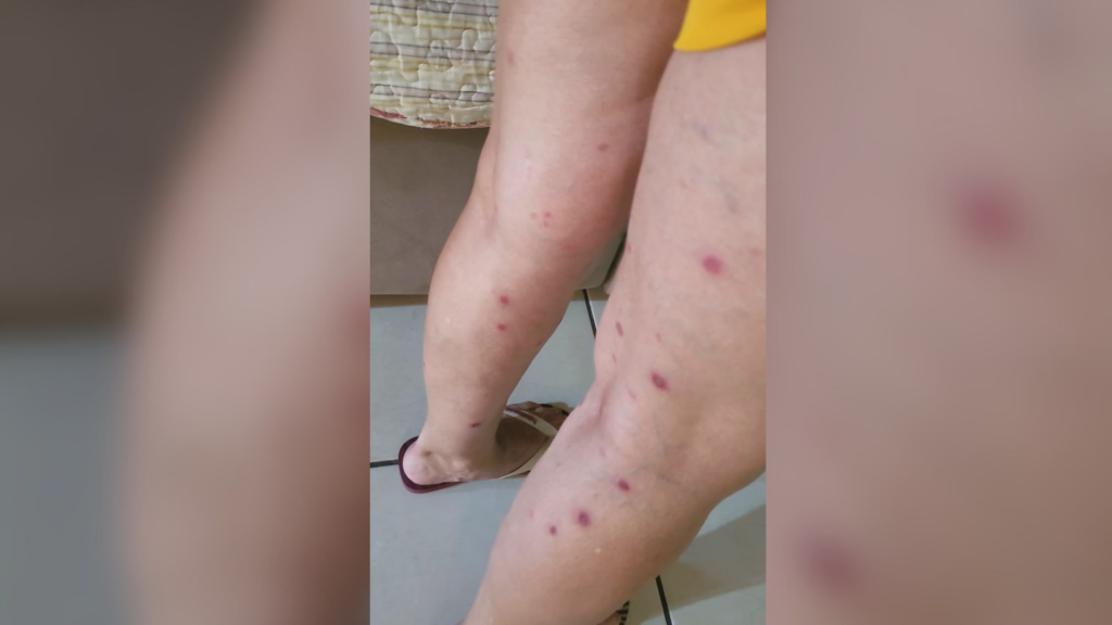 Surto de sarna humana em creches de Estrela D'Oeste afeta crianças e funcionários